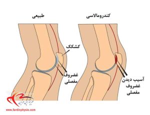 کندرومالاسی کشکک زانو چیست و نقش فیزیوتراپی در بهبود آن