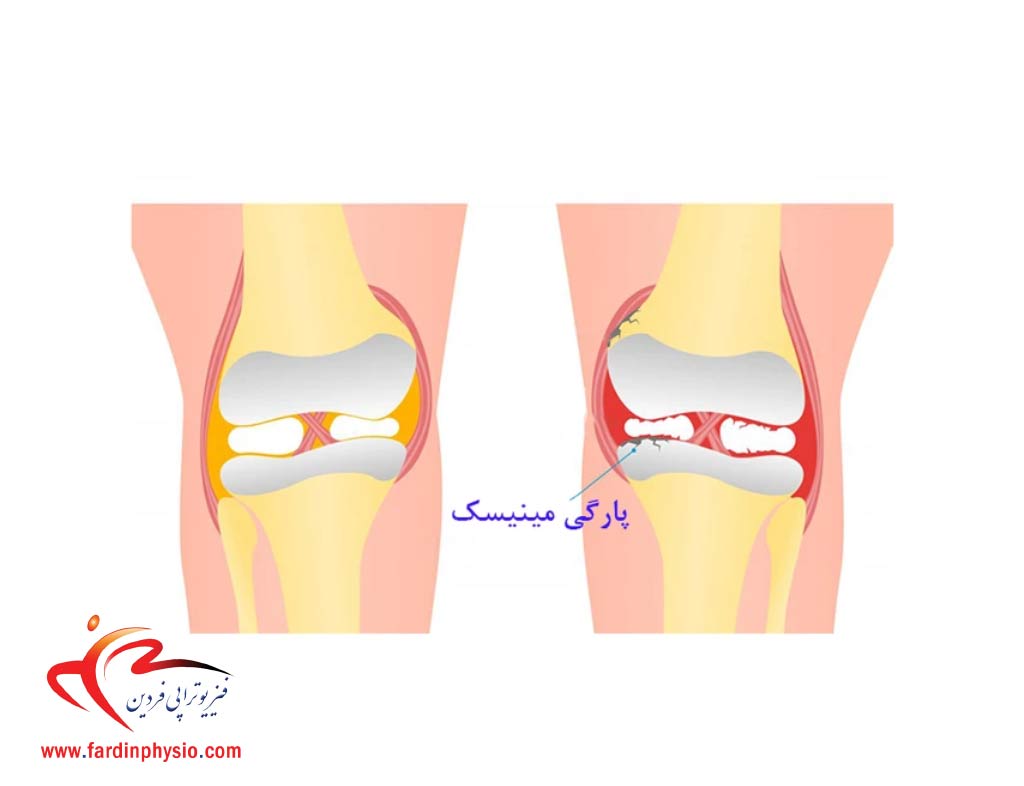 You are currently viewing درمان آسیب و پارگی مینیسک زانو با فیزیوتراپی و بدون جراحی