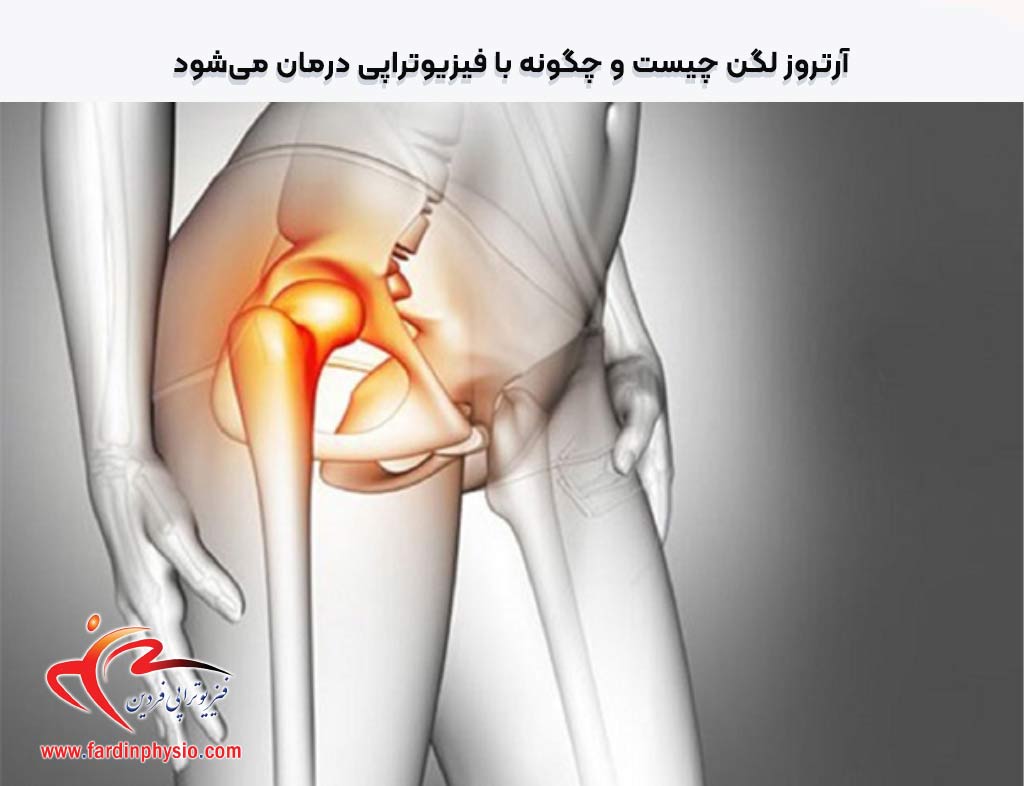 You are currently viewing آرتروز لگن چیست و چگونه با فیزیوتراپی درمان می‌شود