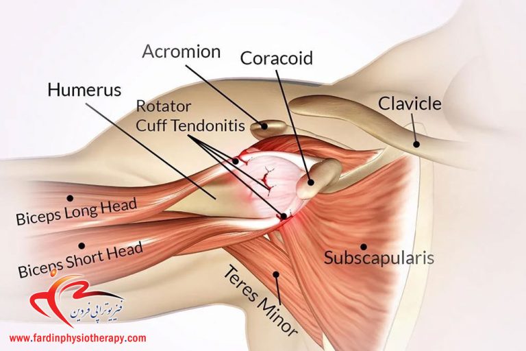 درباره این مقاله بیشتر بخوانید علائم سندروم گیر افتادگی شانه (Impingement) و درمان با فیزیوتراپی