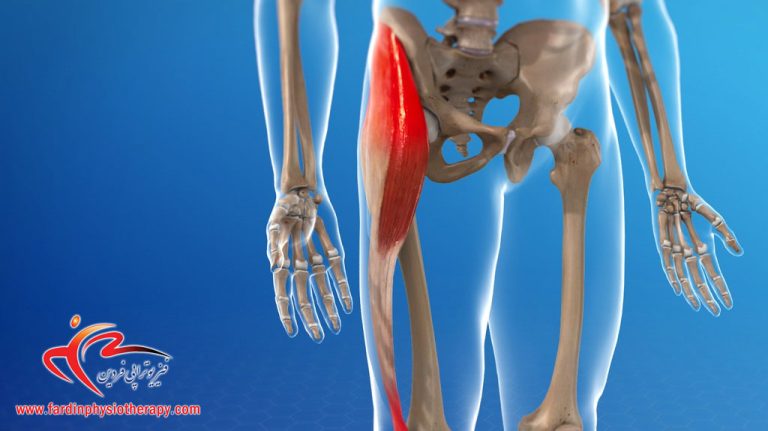 درباره این مقاله بیشتر بخوانید فیزیوتراپی برای سندروم اصطکاک نوار ایلیوتیبیال (ITBS) در ورزشکاران