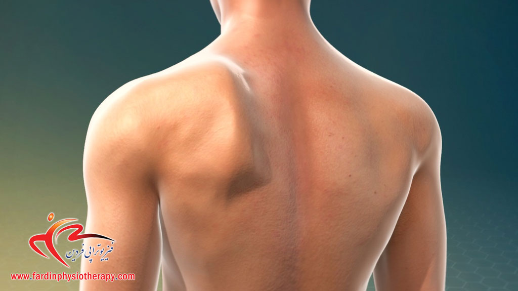 You are currently viewing فیزیوتراپی برای شانه آویزان و سندرم کتف بال‌دار (Winged Scapula)