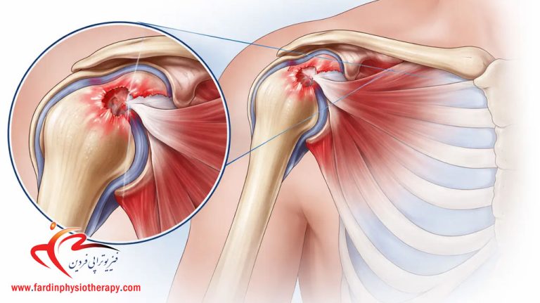 درباره این مقاله بیشتر بخوانید درمان ضایعه اسلپ (SLAP Tear) و آسیب لابروم شانه بدون جراحی با فیزیوتراپی