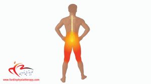 درمان غیرجراحی لغزش مهره کمر (اسپوندیلولیستزیس) با تقویت Core فیزیوتراپی